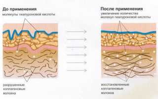 Биоревитализация рук