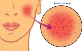 Как убрать сосуды на лице